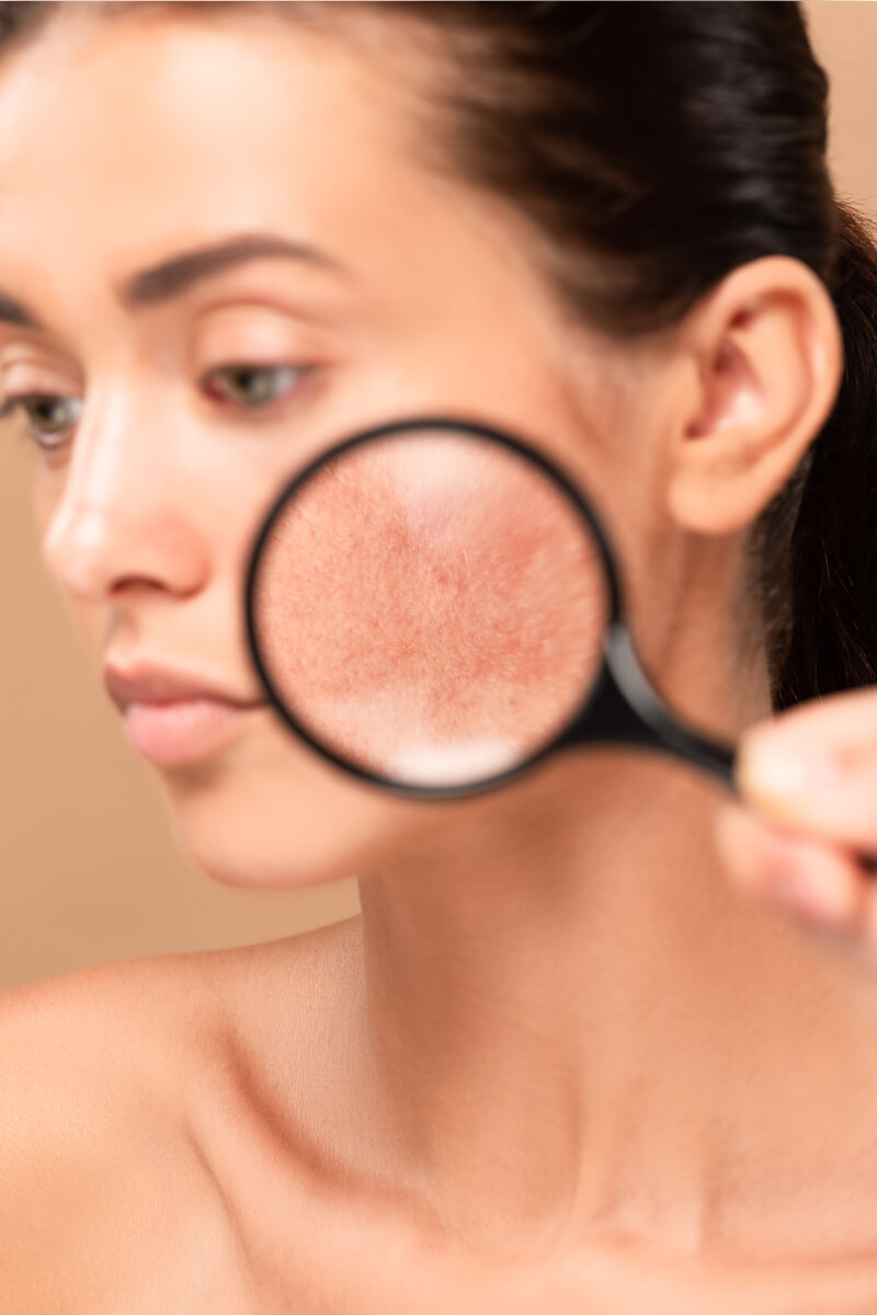 Sensitive Skin - A close-up image showing a young woman with clear, fair skin. A magnifying glass is held near her cheek, emphasizing the texture and slight redness associated with sensitive skin. The woman looks to the side, and the magnifier highlights the detailed appearance of her skin, possibly showing signs of irritation, dryness, or rosacea. This image suggests a focus on skincare concerns, particularly the challenges of managing sensitive skin, which may require gentle care, specific treatments, and products designed to soothe and protect against environmental factors and allergens. The background is softly blurred, drawing attention to the skin's condition.