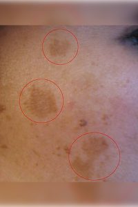 The image you uploaded appears to show skin with dark, irregular patches, which are often associated with melasma. This condition is commonly seen during pregnancy due to hormonal changes that can lead to increased skin pigmentation, particularly in areas exposed to sunlight.