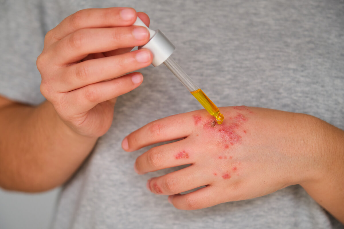 Eczema - A close-up image shows a person applying a drop of yellowish oil from a glass dropper onto inflamed patches of eczema on the back of their left hand. The hand displays red, irritated skin with small blisters and dryness, characteristic of an eczema flare-up. The person is gently holding the dropper, suggesting they are administering a treatment, possibly a natural oil like rosehip or a soothing serum, to alleviate the symptoms. The background, featuring a light gray shirt, is out of focus, directing attention to the skin condition and the treatment process. The image emphasizes the care and attention required in managing eczema.