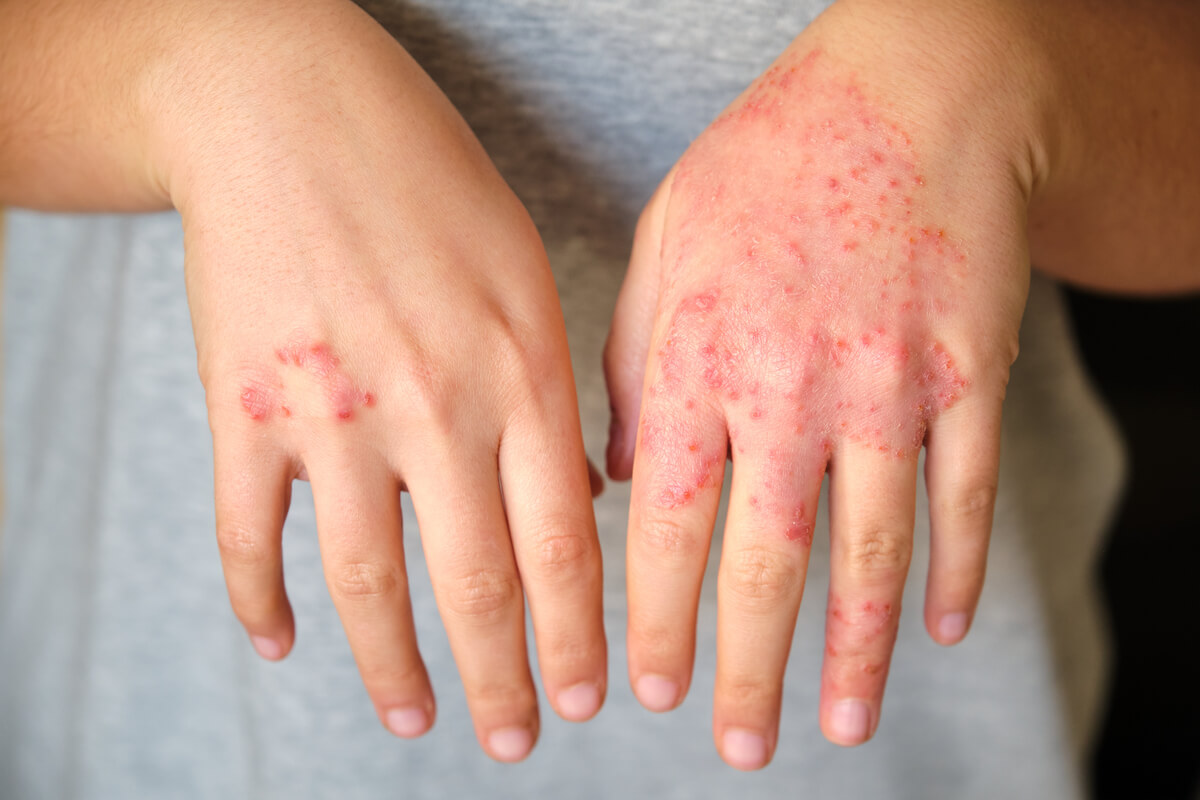 Eczema - A close-up image of a person's hands, highlighting the visible effects of eczema. The right hand shows extensive red, inflamed patches with small blisters and dry, scaly skin, indicative of a flare-up. The left hand also displays some signs of eczema, though to a lesser extent, with smaller patches of redness and irritation. The person is wearing a light gray shirt, and the background is out of focus, ensuring the viewer's attention is drawn to the skin condition. The image illustrates the discomfort and visible symptoms associated with atopic dermatitis, a common form of eczema.